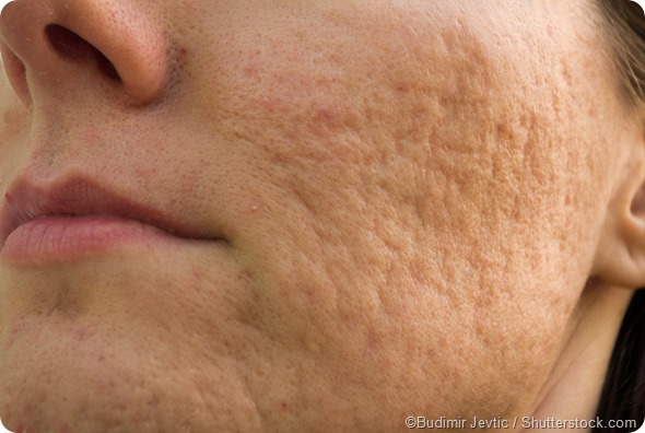 female severe acne scars